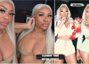 Clermont Twins before surgery style evolution and public transformation explained