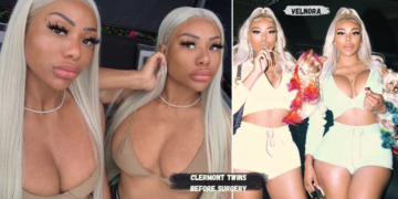 Clermont Twins before surgery style evolution and public transformation explained
